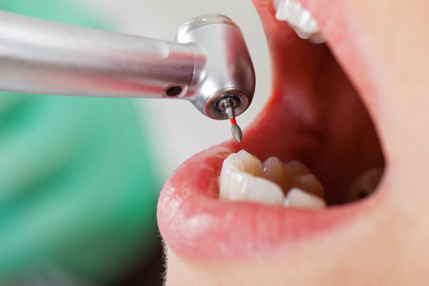 Best Emergency Wisdom Teeth Removal in Broadlands, VA